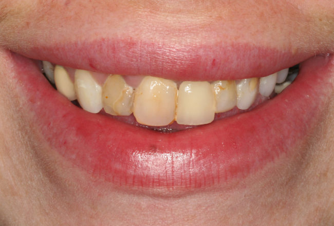 Replace Bonding and Bridges with Porcelain Veneers - Before