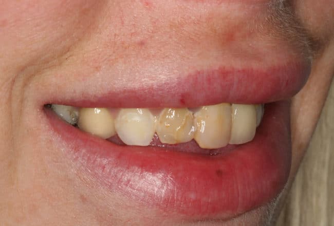 Replace Bonding and Bridges with Porcelain Veneers - Before