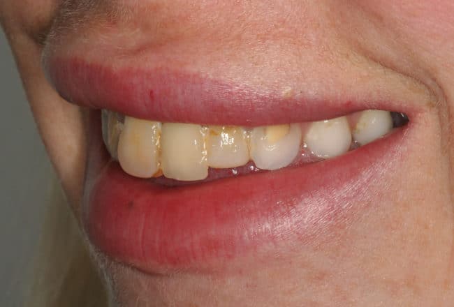 Replace Bonding and Bridges with Porcelain Veneers - Before