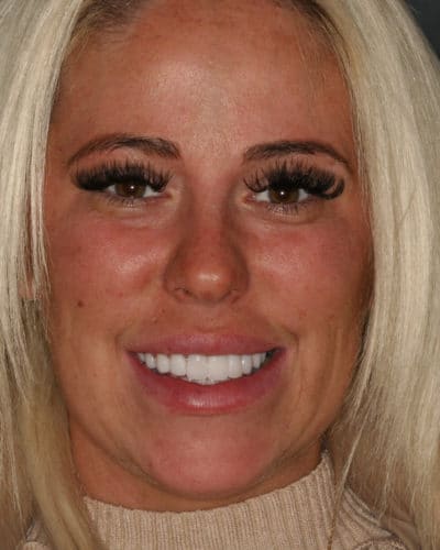 Replace Bonding and Bridges with Porcelain Veneers