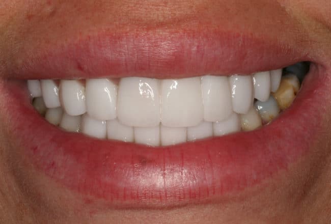 Replace Bonding and Bridges with Porcelain Veneers - After
