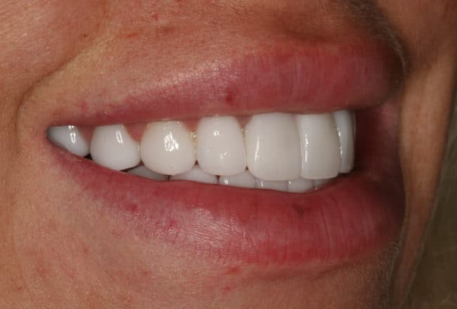 Replace Bonding and Bridges with Porcelain Veneers - After