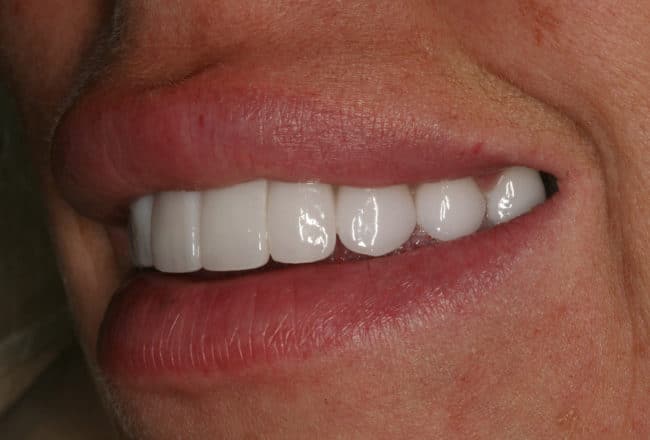 Replace Bonding and Bridges with Porcelain Veneers - After