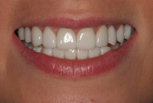 Discoloured Teeth? - Upper & Lower Porcelain Veneers - After