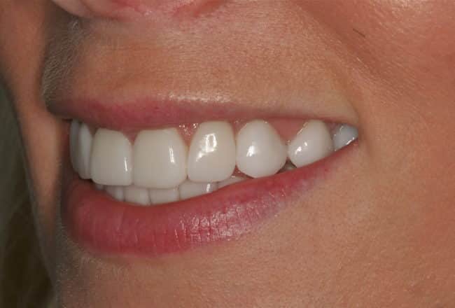 Discoloured Teeth? - Upper & Lower Porcelain Veneers - After