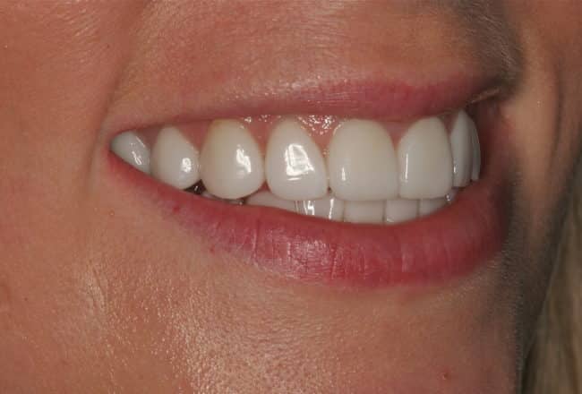 Discoloured Teeth? - Upper & Lower Porcelain Veneers - After