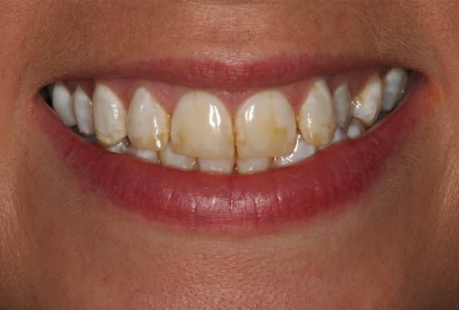 Discoloured Teeth? - Upper & Lower Porcelain Veneers - Before