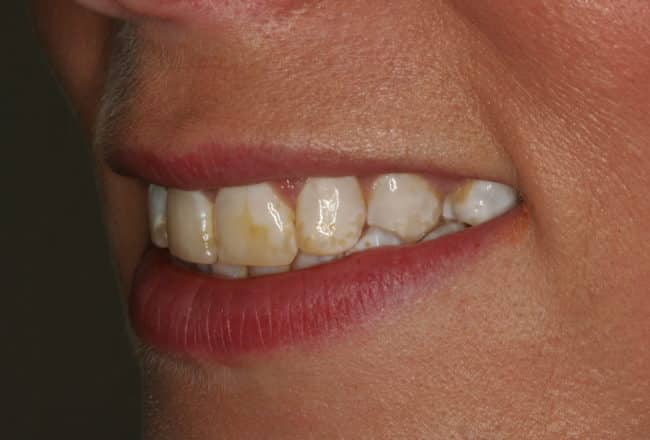 Discoloured Teeth? - Upper & Lower Porcelain Veneers - Before