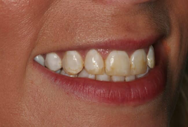 Discoloured Teeth? - Upper & Lower Porcelain Veneers - Before