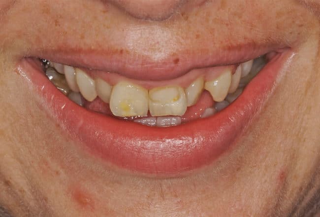 Veneers for Straightening and Widening Smile - Before