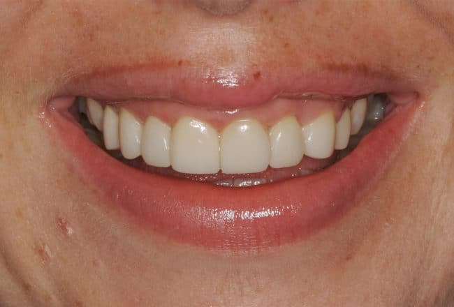 Veneers for Straightening and Widening Smile - After