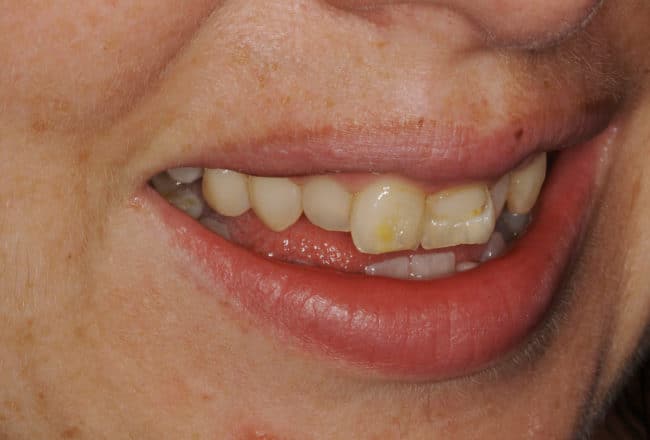Veneers for Straightening and Widening Smile - Before