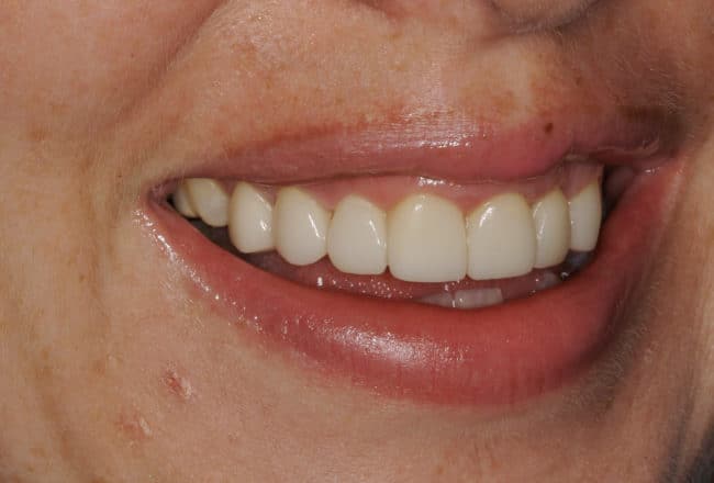 Veneers for Straightening and Widening Smile - After