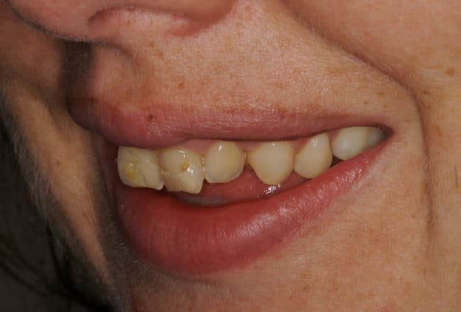 Veneers for Straightening and Widening Smile - Before