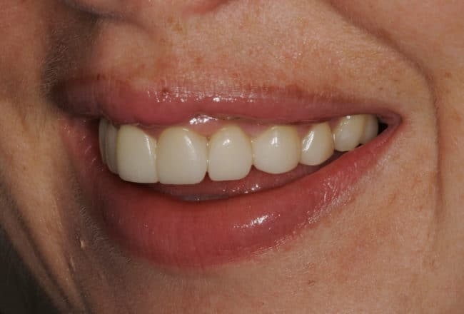 Veneers for Straightening and Widening Smile - After
