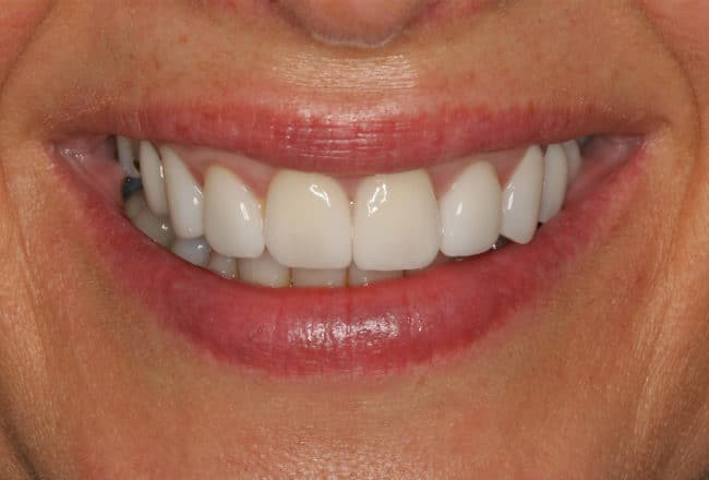 Veneers, Bridges & Crowns for a Perfect Smile - after