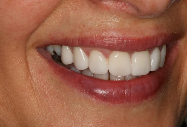 Veneers, Bridges & Crowns for a Perfect Smile - after