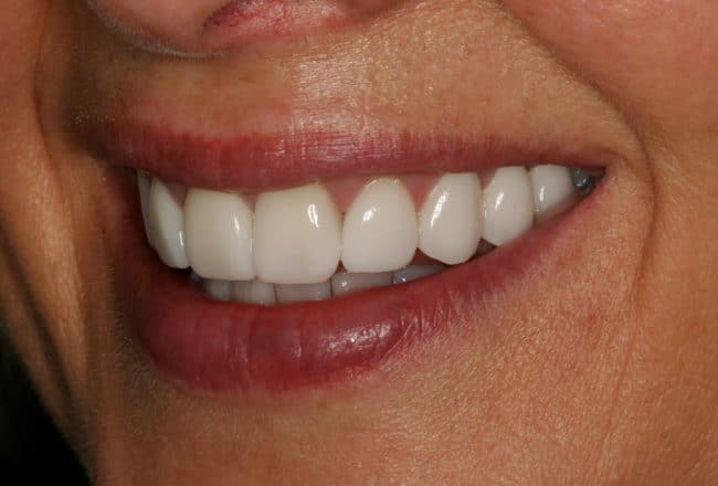 Veneers, Bridges & Crowns for a Perfect Smile - after