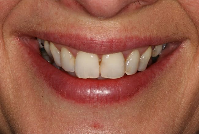 Veneers, Bridges & Crowns for a Perfect Smile - before
