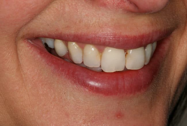 Veneers, Bridges & Crowns for a Perfect Smile - before