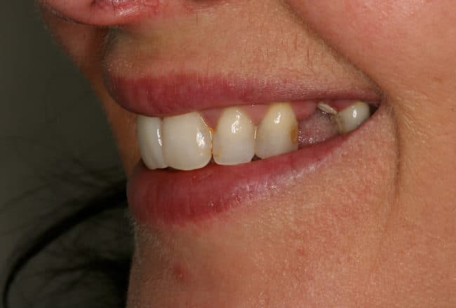 Veneers, Bridges & Crowns for a Perfect Smile - before
