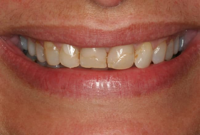 Upper and Lower Veneers: Whiten & Straighten Teeth - Before