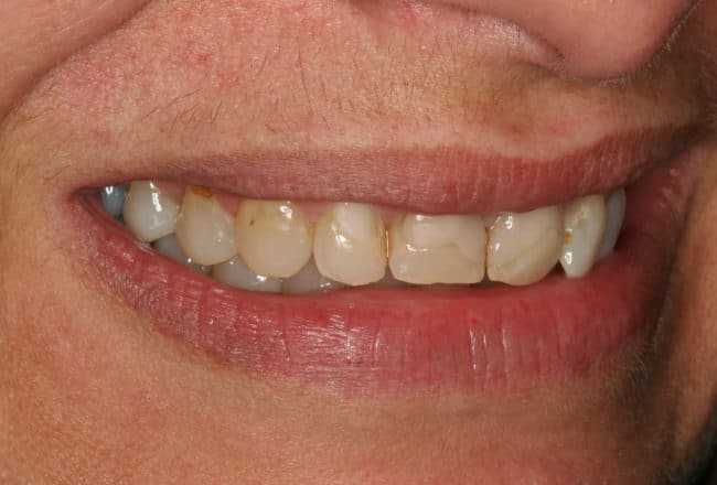 Upper and Lower Veneers: Whiten & Straighten Teeth - Before