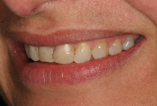 Upper and Lower Veneers: Whiten & Straighten Teeth - Before