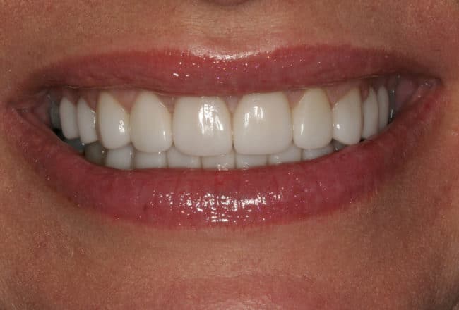 Upper and Lower Veneers: Whiten & Straighten Teeth - After