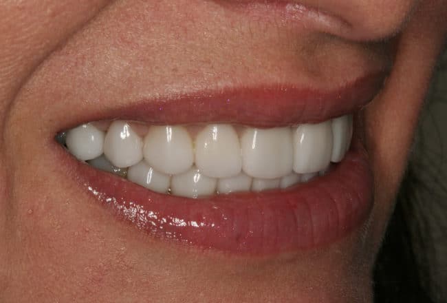 Upper and Lower Veneers: Whiten & Straighten Teeth - After