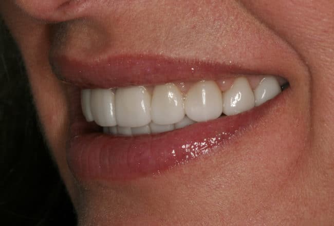 Upper and Lower Veneers: Whiten & Straighten Teeth - After