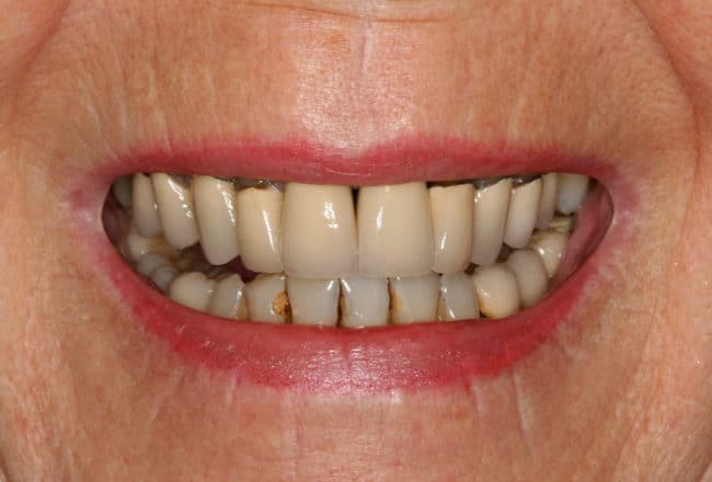 Replacing Metal Crowns with Porcelain for Gum Disease - Before