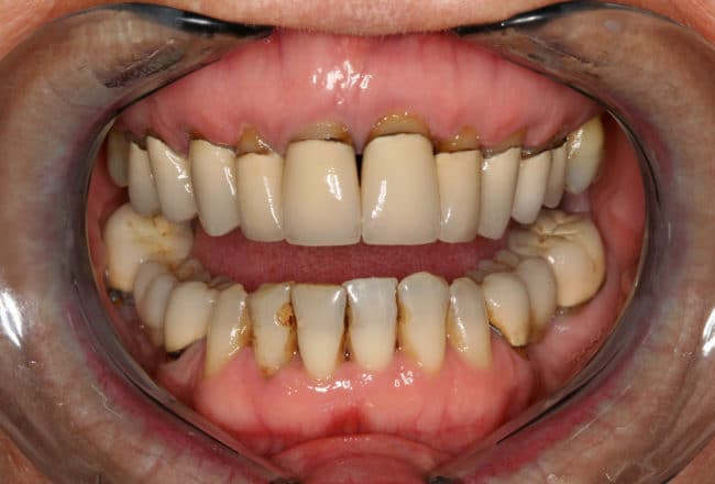 Replacing Metal Crowns with Porcelain for Gum Disease - Before