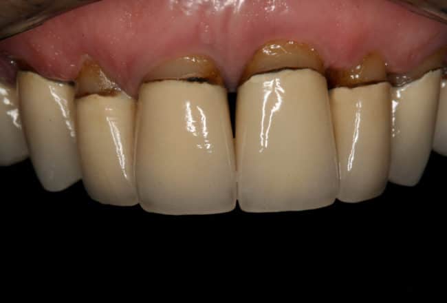 Replacing Metal Crowns with Porcelain for Gum Disease - Before