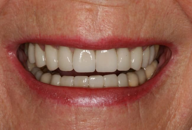 Replacing Metal Crowns with Porcelain for Gum Disease - After