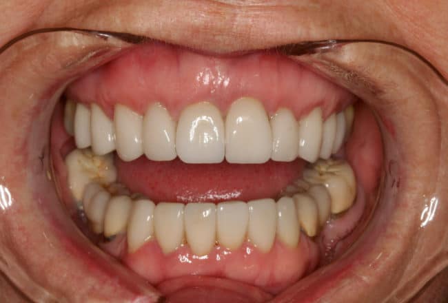 Replacing Metal Crowns with Porcelain for Gum Disease - After