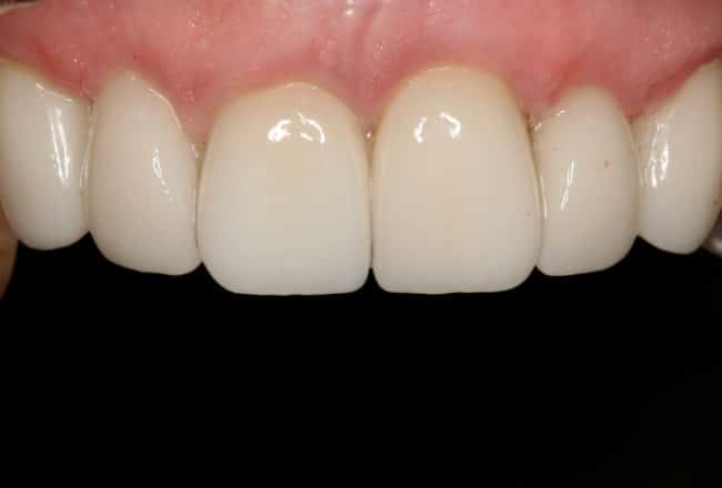 Replacing Metal Crowns with Porcelain for Gum Disease - After