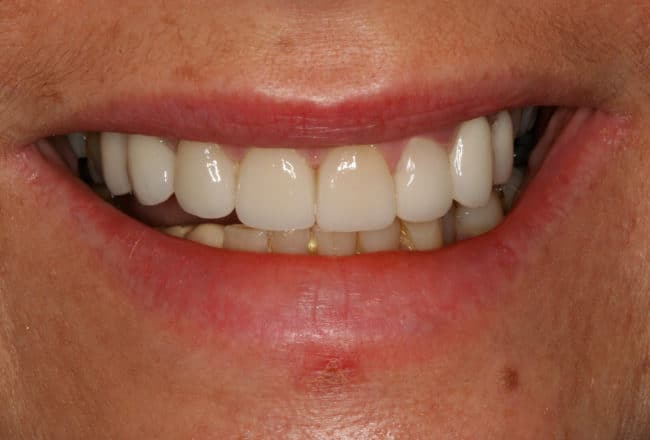 Porcelain Veneers & Replacement Bridge - After
