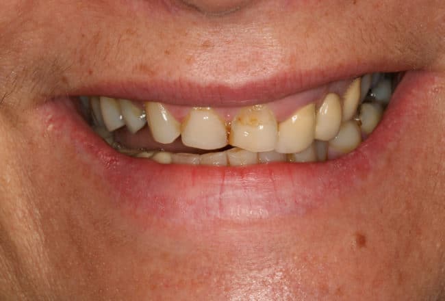 Porcelain Veneers & Replacement Bridge - Before