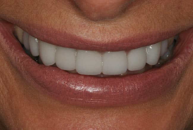 Perfect Smile with Porcelain Crowns & Bridges - After