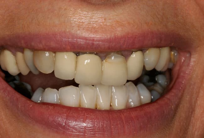 Perfect Smile with Porcelain Crowns & Bridges - before