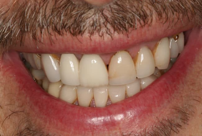 Upper & Lower Crowns, Porcelain Veneers, Implants - before