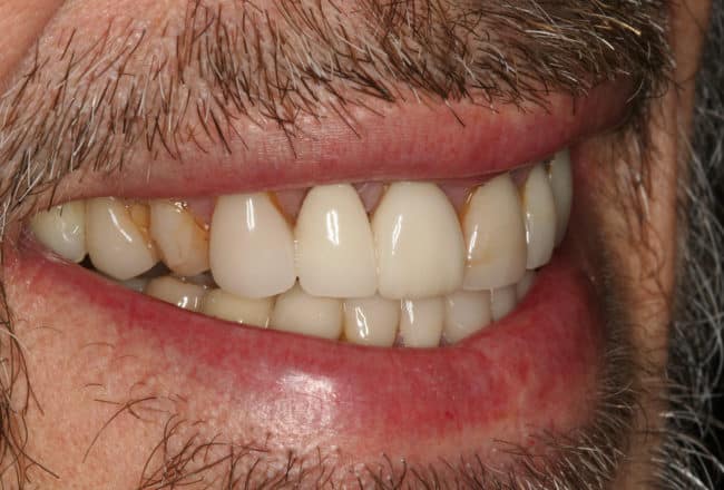 Upper & Lower Crowns, Porcelain Veneers, Implants - before