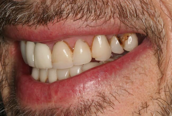 Upper & Lower Crowns, Porcelain Veneers, Implants - before