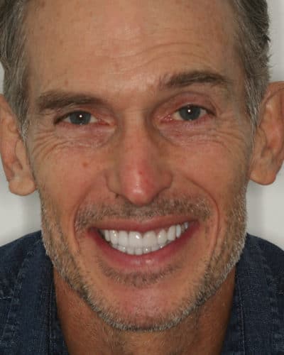 Upper & Lower Crowns, Porcelain Veneers, Implants