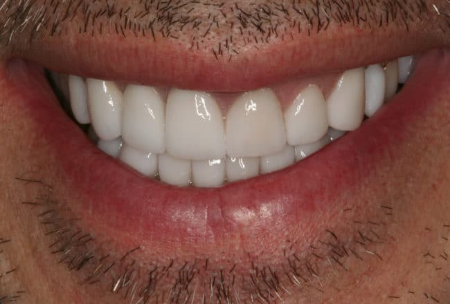 Upper & Lower Crowns, Porcelain Veneers, Implants - after