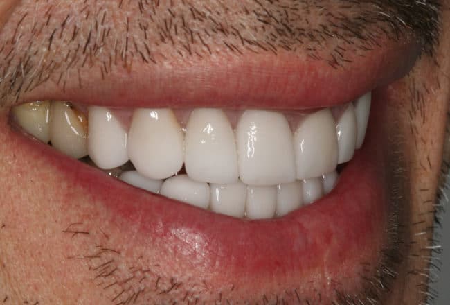 Upper & Lower Crowns, Porcelain Veneers, Implants - after