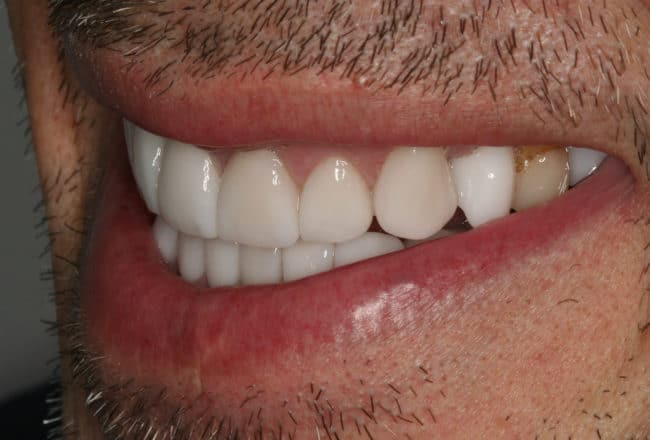 Upper & Lower Crowns, Porcelain Veneers, Implants - after