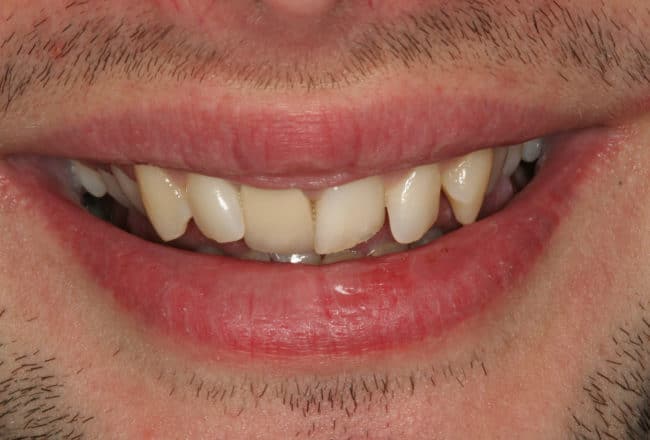 Minimal Prep Porcelain Veneers | Smile Makeover - Before