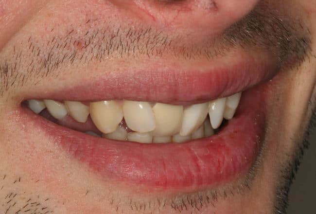 Minimal Prep Porcelain Veneers | Smile Makeover - Before